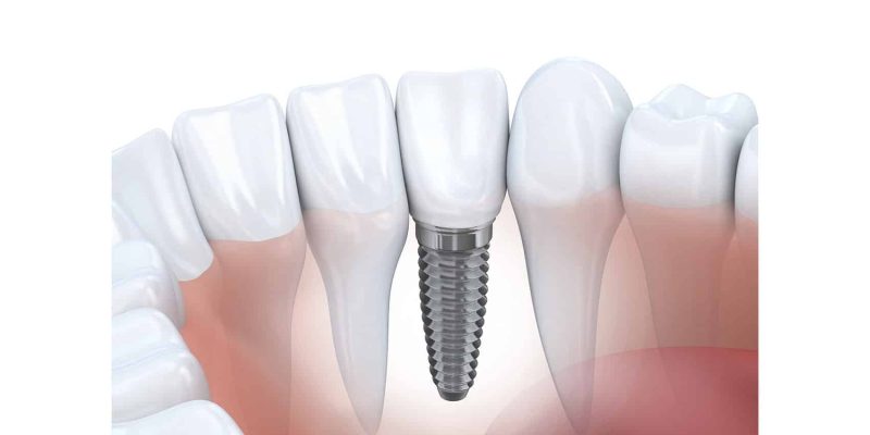 Implant dentaire : Un implant remarquable ?