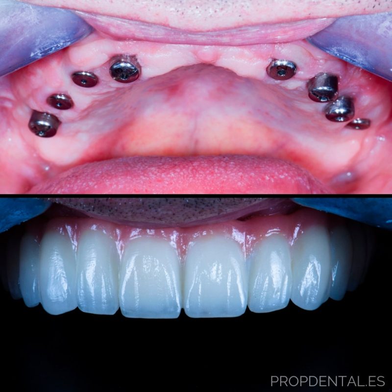 Implant dentaire : Quels sont les atouts de l’implant ?