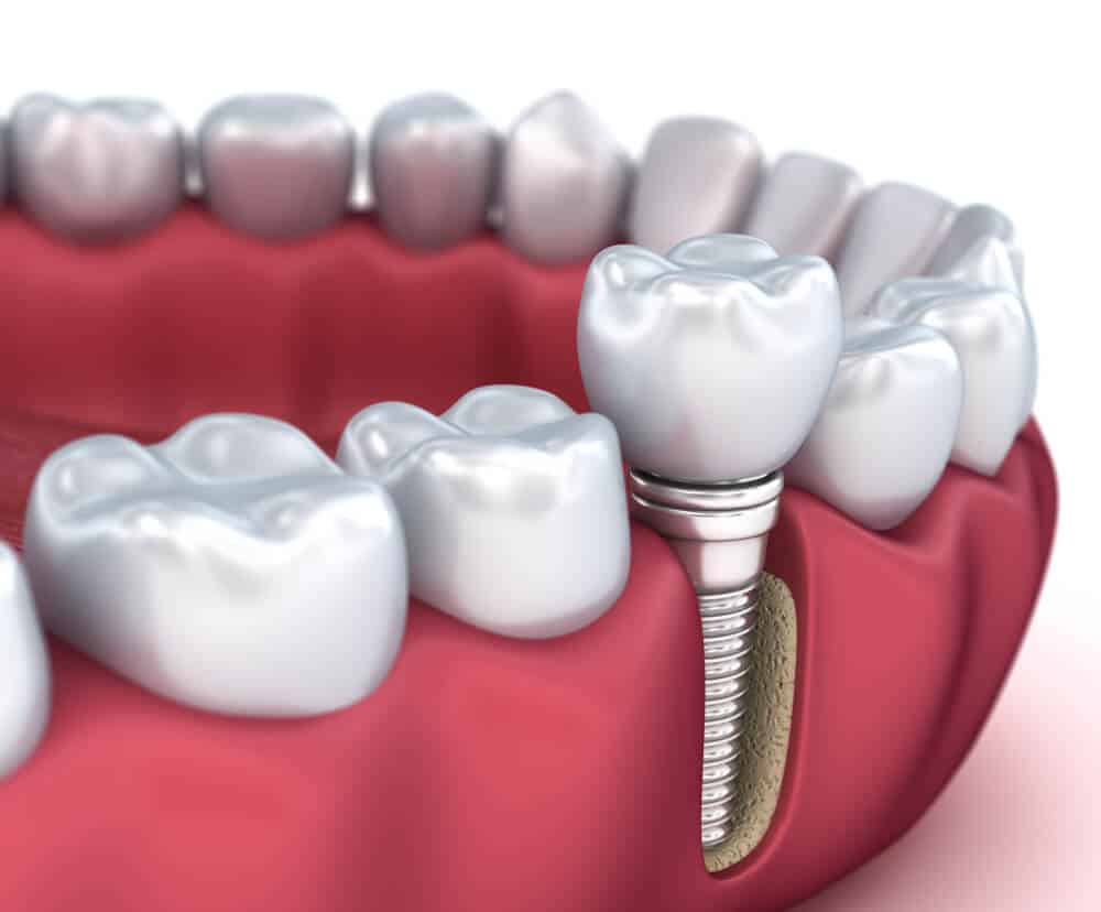 Implant dentaire : quels sont ses inconvénients ?